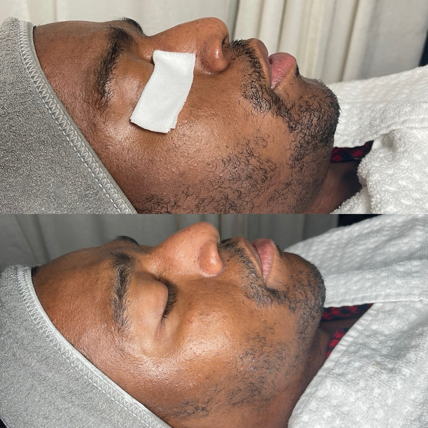 A man’s cheek before and after a facial, clearer and smoother.