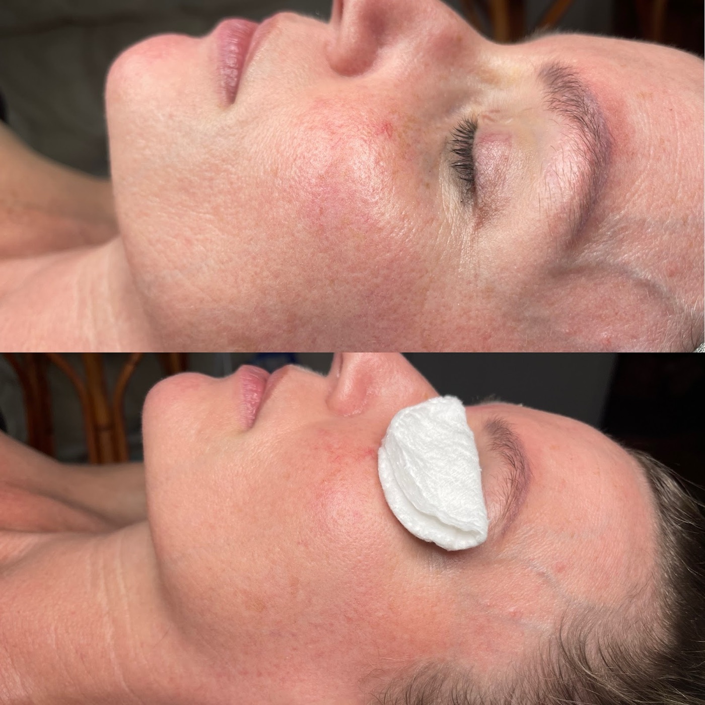 A woman’s cheek before and after a facial, looking calmer and more even.