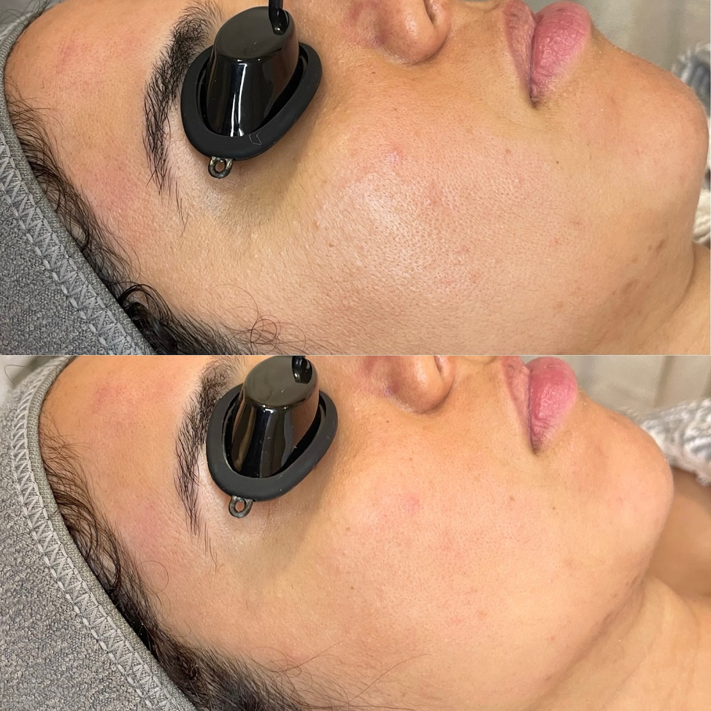 A facial treatment in progress, with smoother, more even skin in the lower frame.